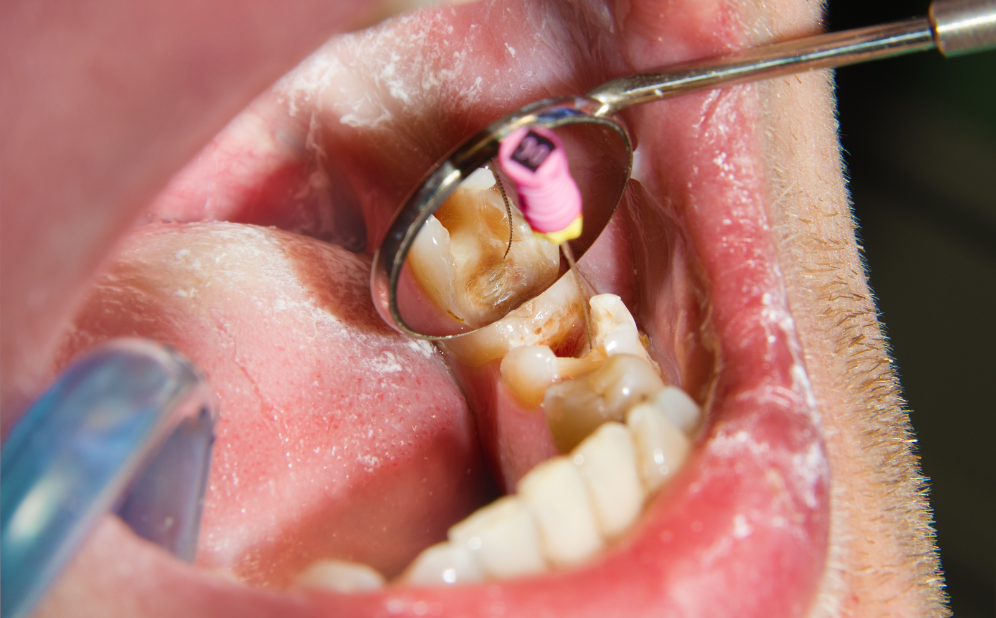 Dental Fillings - Best dental clinic in bogura