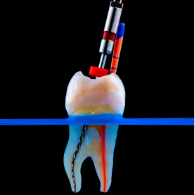 Pain-free root canal treatment at Namira Oro Dental Care in Bogura